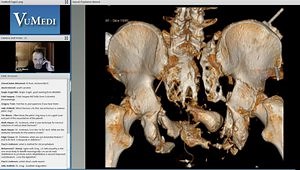 Surgical Treatment of Sacral Fracture