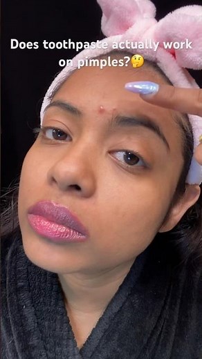 Does toothpaste actually work on pimples? #acnetreatment #acne #acneremedy #skincarehacks #shorts
