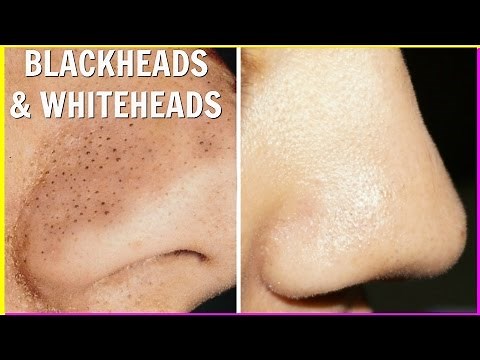 How to Get Rid of Blackheads & Whiteheads At Home Instantly | Anaysa