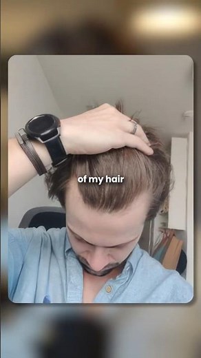 My hair came back after Finasteride stopped working #hairrestoration #minoxidil #alopecia