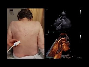 Left interscapular approach (LISA) in Stanford type A aortic dissection