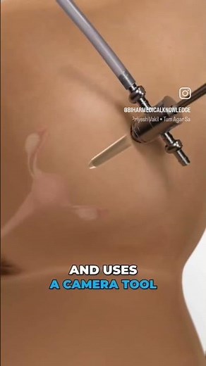 #tubectomy procedure 🫣🫣