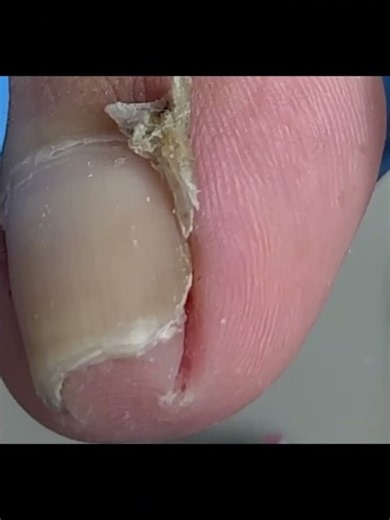 Ingrown nails dig deep into the toes, gently separating #nails #satisfying
