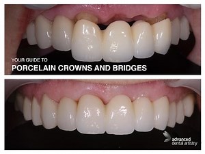 Porcelain Crowns and Bridges