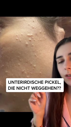 So bekommst du unterirdische Pickel endlich los!