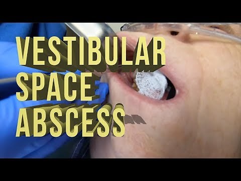 Vestibular Space Abscess