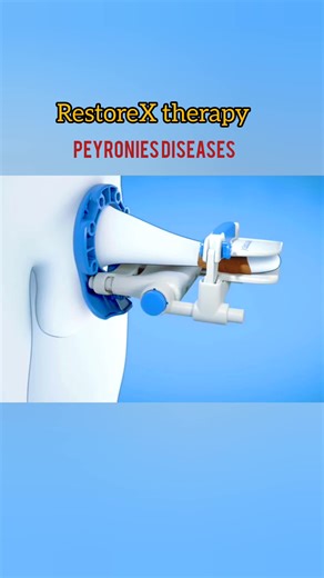 Peyronies Disease RestoreX therapy treatment procedure 3D medical animation USA 🇺🇸 FDA Approved #healtheducation #fdaapproved #peyroniesdisease #shockwavetherapy #RestoreX