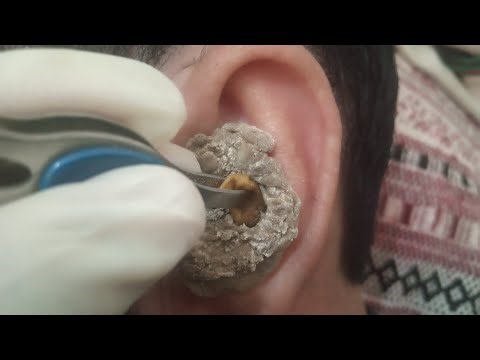 👍ASMR Ear Cleaning - Real Case Of Hearing Blockades Solved 