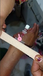 IV Cannulation technique