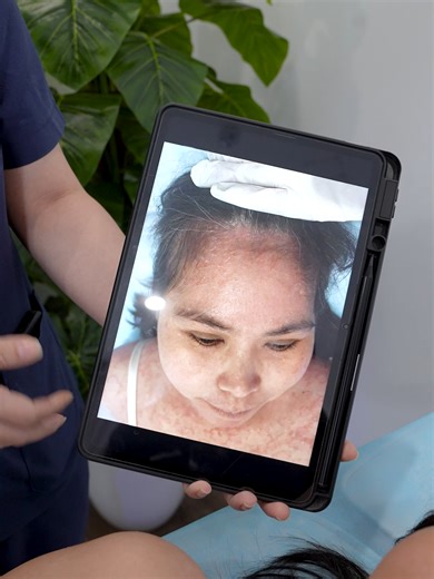 🌿 “Từng lo rằng làn da bong tróc sẽ không thể cải thiện…” Nhưng chỉ sau vài buổi tại St. Paul Clinic, chị Sen đã tự tin với làn da mịn màng hơn 💚 Được đội ngũ chuyên gia da liễu hàng đầu Việt Nam – trực tiếp thăm khám & chỉ định liệu trình ánh sáng EXCIMER 308nm, tình trạng cải thiện rõ rệt chỉ sau thời gian ngắn ✨ Đăng ký ngay để được điều trị sớm nhất! #vaynen #viemdacodia