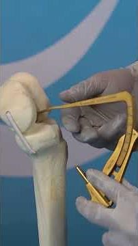 ACL Reconstruction Surgery: A Step-by-Step Guide with Dr. Kushan Vaghela