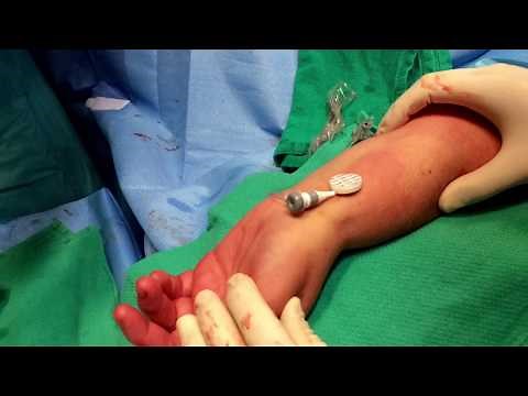 StatSeal Advanced Disc + Merit Medical SafeGuard radial artery sheath removal