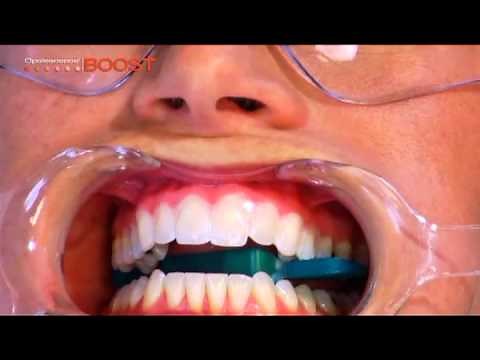 OPALESCENCE BOOST Teeth Whitening