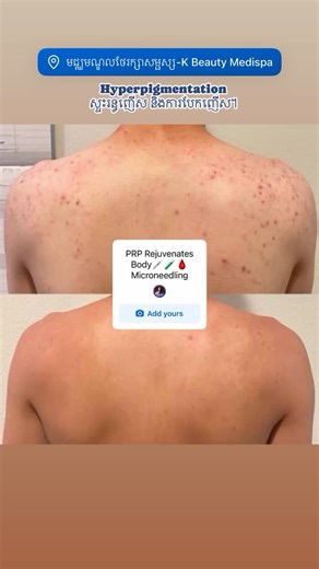 តើអ្នកដឹងទេថា ការព្យាបាលដោយប្រើម្ជុលតូចៗ (Microneedling) មិនត្រឹមតែសម្រាប់តែមុខប៉ុណ្ណោះទេ? អតិថិជនរូបនេះបានធ្វើការព្យាបាលដោយប្រើម្ជុលតូចៗ (Collagen Induction Therapy) នៅលើខ្នងរបស់នាង ដើម្បីជួយដោះស្រាយបញ្ហាស្នាមអុចខ្មៅក្រោយការរលាក ទាំងនេះគឺជាលទ្ធផលបន្ទាប់ពី…ព្យាបាល #kbeautymedispa #sihanoukville #ក្រុងព្រះសីហនុ #aesthetic #prptreatment