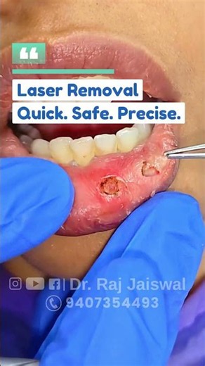 Mucocele || Swelling Inside Your Mouth || Dr. Raj jaiswal #shortvideo #oralhealth