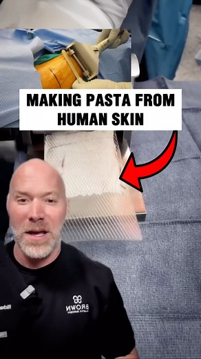 Doctor Ricky | Plastic Surgeon on Instagram: "- 🤔 Understanding Split Thickness Skin Grafts (STSG): … - 🩹 What They Are: STSG involves transplanting skin layers to damaged areas. … - 🚑 Healing Wounds: Used for burns, injuries, or skin loss from surgery. … - 💡 Thin Layer: Only the top two layers of skin are transplanted. … - 🔄 Healing Process: The donor site heals quickly, regenerating skin. … - ⚖️ Pros & Cons: Effective but can lead to color/texture differences. … - 🌱 Aftercare Is Key: Pro