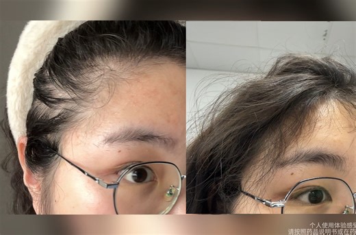 脱发头秃的救星—长周期使用效果