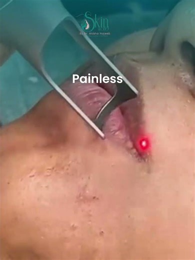 The Secret to Pink, Glowing Lips: Laser Lip Toning Explained