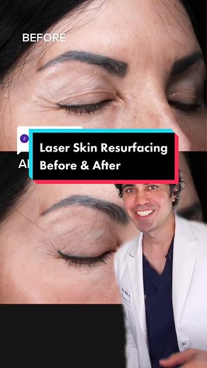 Laser Skin Rejuvenation Before and After Results