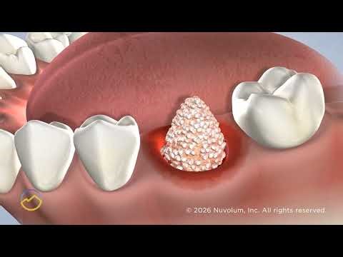 Bone Grafting in El Dorado Hills, CA