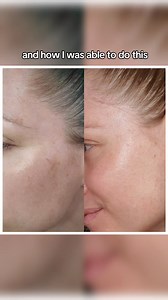 5K views · 58 reactions | My REAL skin transformation with goPure skincare! This routine can be done day or night. For daytime be sure to use Sunscreen. At night you can add in the Firm & Lift Retinoid and Bakuchiol Serum. Results always vary and they take time. Be patient and stay consistent ✨ #skintransformation #darkspottreatment #darkspotroutine #skincareroutine #skincare101 #daytimeskincareroutine #gopure #gopureglow | GoPure Skin Care | Facebook