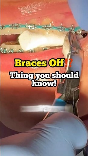 Braces Off - Things you should know - Toothtime Family Dentistry