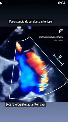Persistencia del conducto arterioso