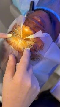 Eye Color Change for an amazing patient at KERATO by Dr.Movshovich