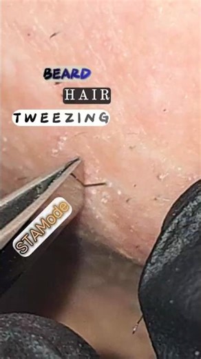 Beard Hair Tweezing — The Exact Moment It Comes Out 😬