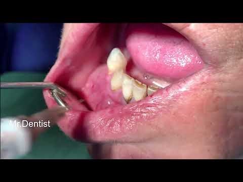 Extraction Of The Lower Right Canine Tooth !!!!!