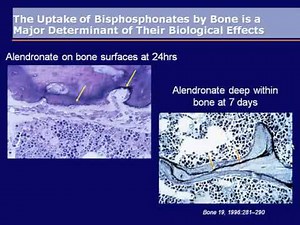 Zoledronic Acid Once Yearly Infusion: A Step Forward in Fracture Prevention