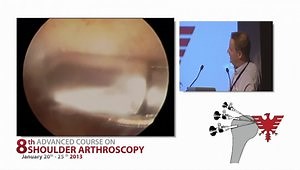 How I Do An Arthroscopic AC Joint Resection