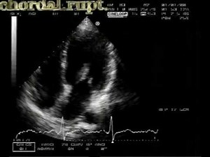 echocardiogram : chordal rupture 2/2