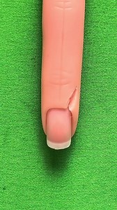 5K views | Proximal nail fold nevus excision (part 2) | Dermhacks | Facebook