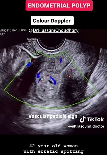 Understanding Endometrial Polyps: Symptoms and Effects