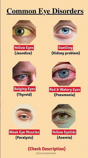 Your Eyes Are Speaking 👁️ | Disease Warning Signs Explained #health #healthylifestyle #healthtips