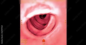 CT colonography or CT Scan of large intestine 3D rendering on the screen for diagnosis large bowel cancer or colon cancer and colorectal cancer.