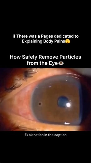 Explaining Human Pains | When a foreign particle enters the eye, it can cause irritation, pain, redness, and blurred vision. In this procedure, an eye specialist... | Instagram
