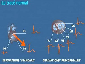 CARDIOLOGIE ECG Normal et Pathologique