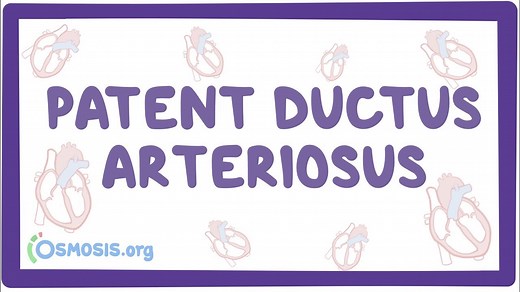Patent ductus arteriosus: Video, Causes, & Meaning | Osmosis