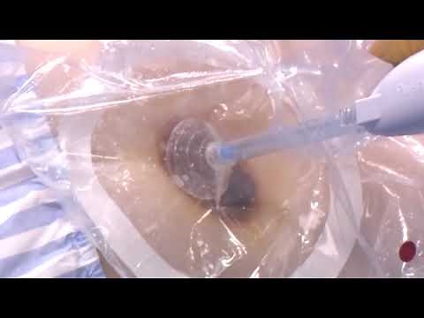 PULSAR II™ ADVANCED WOUND IRRIGATION (AWI)™ WOUND DEBRIDEMENT SYSTEM