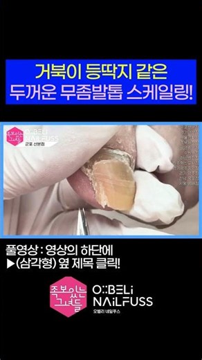 Scaling a thick, turtle-shell-like fungal toenail! 😍 #ingrowntoenails #toenails #ingrown_toenail ...