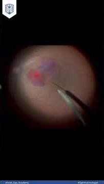 Educational Video 45: Unlocking Vision: Subretinal Injection of tPA in Submacular Hemorrhage