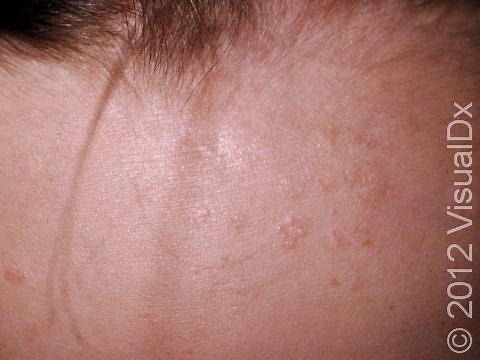 Flat Wart (HPV): Causes, Symptoms, and Treatment