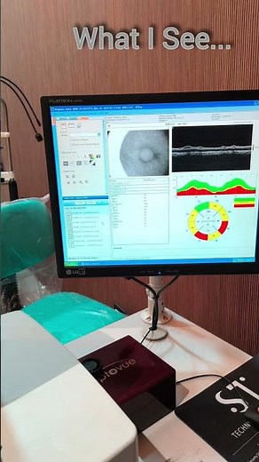 OCT:RNFL for early detection of Glaucoma #glaucomascreening #glaucomaday #worldglaucomaday