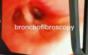 bronchofibroscopy纤支镜检查