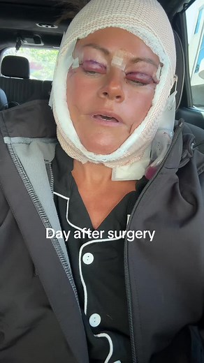 Upper bleph, low face and neck lift, day 1 post surgery. Thanks for all the prayers, good vibes, and sweet comments.