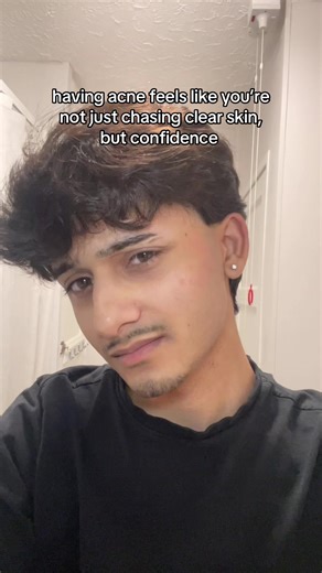 Struggling with Acne: Chasing Clear Skin & Confidence