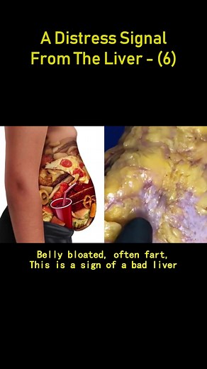 #cirrhosis #fattyliver #liverdetox #livercirrhosis #fyp #liverdetox #health