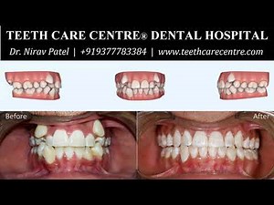 Invisalign Before and After - Crowded Teeth